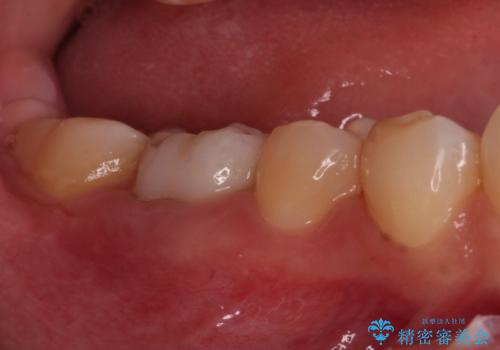 虫歯と抜いたままの奥歯とデコボコの前歯 総合歯科治療の治療後