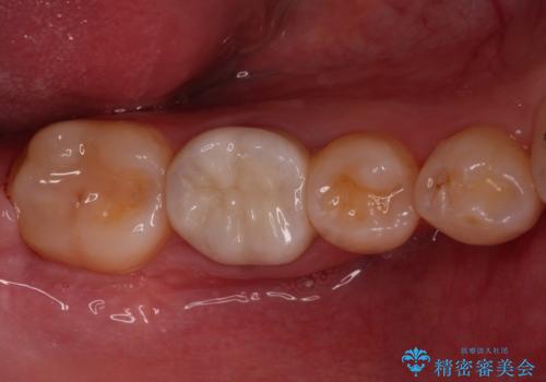 虫歯と抜いたままの奥歯とデコボコの前歯 総合歯科治療の治療後