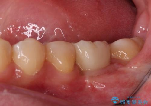 虫歯と抜いたままの奥歯とデコボコの前歯 総合歯科治療の治療後