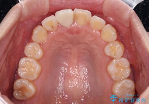 虫歯と抜いたままの奥歯とデコボコの前歯 総合歯科治療の治療後