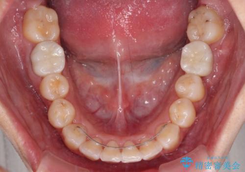 虫歯と抜いたままの奥歯とデコボコの前歯 総合歯科治療の治療後