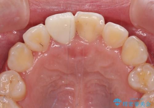 虫歯と抜いたままの奥歯とデコボコの前歯 総合歯科治療の治療後