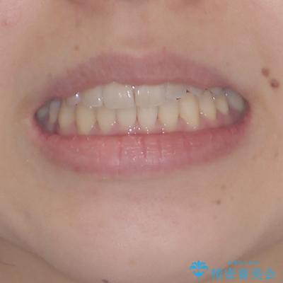 狭い歯列を拡大　拡大装置を併用したインビザライン矯正の治療後（顔貌）