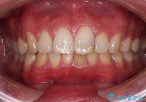 気になる前歯を短期間で改善 下顎の部分矯正と上顎のオールセラミッククラウンの治療前