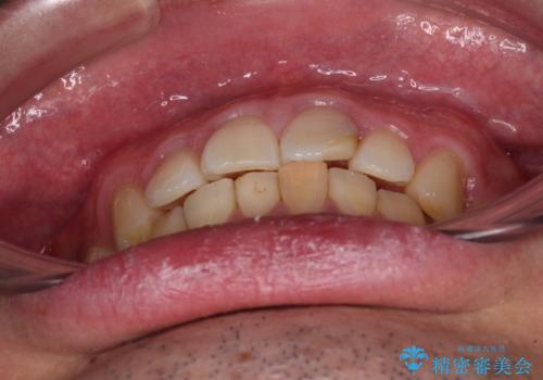 気になる前歯を短期間で改善 下顎の部分矯正と上顎のオールセラミッククラウンの治療前