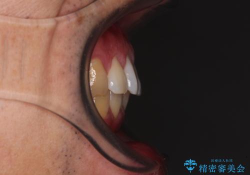 気になる前歯を短期間で改善 下顎の部分矯正と上顎のオールセラミッククラウンの治療前