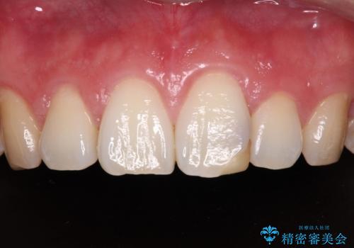 気になる前歯を短期間で改善　下顎の部分矯正と上顎のオールセラミッククラウンの症例 治療前