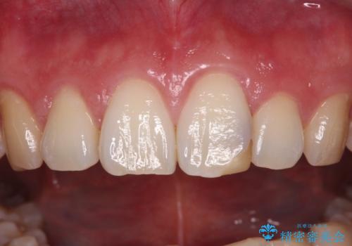 気になる前歯を短期間で改善 下顎の部分矯正と上顎のオールセラミッククラウンの治療前