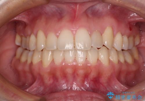 狭い歯列を拡大　拡大装置を併用したインビザライン矯正の症例 治療後