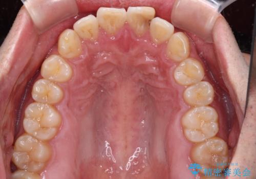 気になる前歯を短期間で改善　下顎の部分矯正と上顎のオールセラミッククラウンの治療前