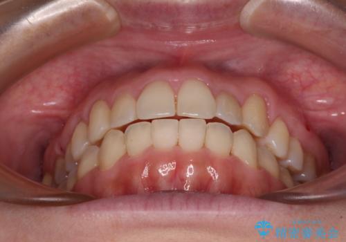 狭い歯列を拡大 拡大装置を併用したインビザライン矯正の治療後