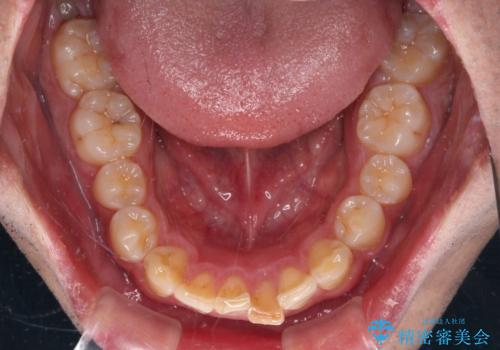 気になる前歯を短期間で改善　下顎の部分矯正と上顎のオールセラミッククラウンの治療前