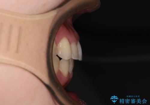 狭い歯列を拡大 拡大装置を併用したインビザライン矯正の治療後