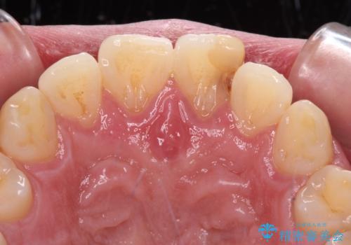 気になる前歯を短期間で改善 下顎の部分矯正と上顎のオールセラミッククラウンの治療前