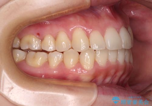 狭い歯列を拡大 拡大装置を併用したインビザライン矯正の治療後