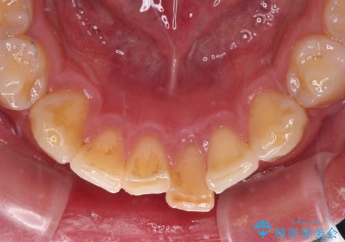 気になる前歯を短期間で改善 下顎の部分矯正と上顎のオールセラミッククラウンの治療前