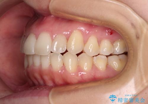 狭い歯列を拡大 拡大装置を併用したインビザライン矯正の治療後