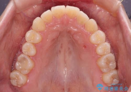 狭い歯列を拡大 拡大装置を併用したインビザライン矯正の治療後