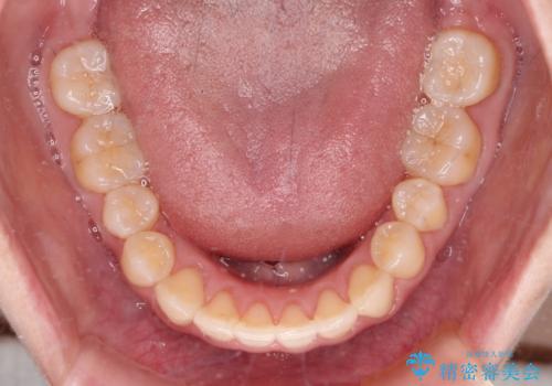 狭い歯列を拡大　拡大装置を併用したインビザライン矯正の治療後