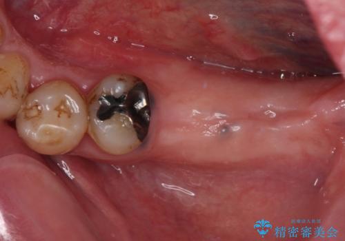 奥歯で噛みたい　インプラントによる欠損補綴治療の症例 治療前