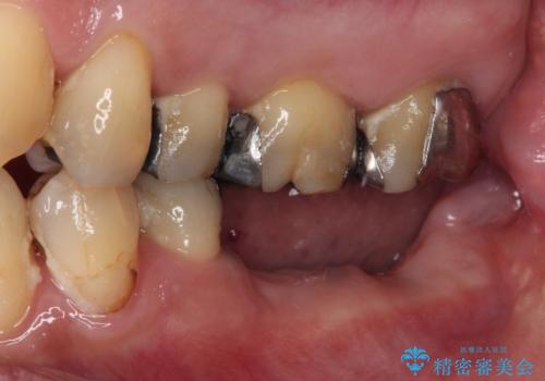 奥歯で噛みたい　インプラントによる欠損補綴治療の治療前
