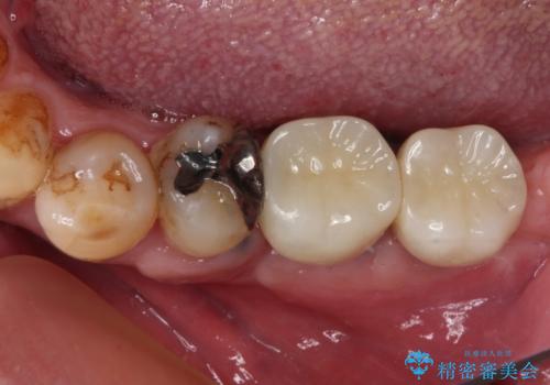 奥歯で噛みたい　インプラントによる欠損補綴治療の症例 治療後