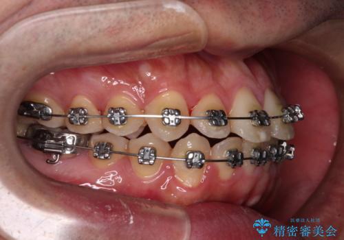 早くて安くて楽ちん メタルブラケットでの矯正治療の治療中