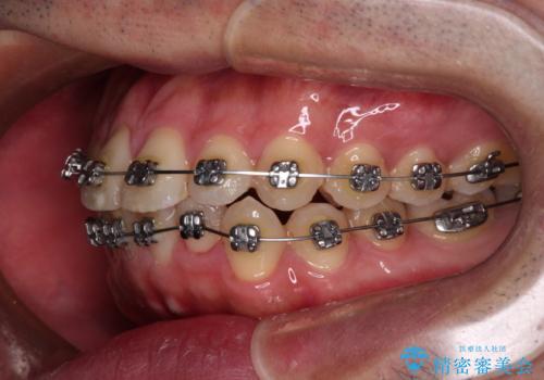 早くて安くて楽ちん メタルブラケットでの矯正治療の治療中