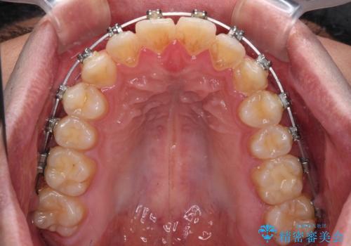 早くて安くて楽ちん メタルブラケットでの矯正治療の治療中