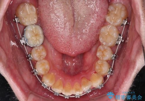 早くて安くて楽ちん メタルブラケットでの矯正治療の治療中