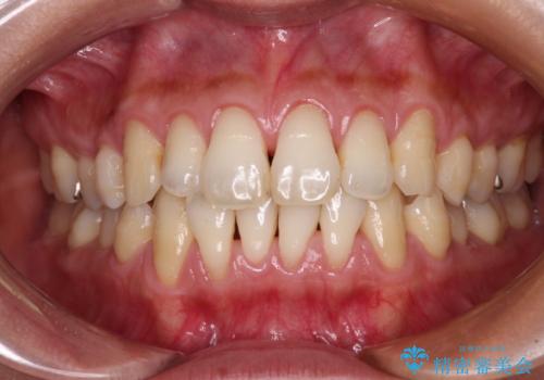 年々下がる歯茎を何とかしたい　歯肉移植術による根面被覆の治療前