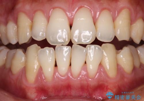 年々下がる歯茎を何とかしたい 歯肉移植術による根面被覆の治療前