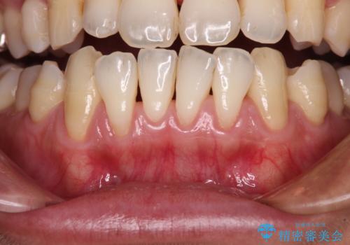 年々下がる歯茎を何とかしたい　歯肉移植術による根面被覆の治療前