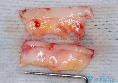 年々下がる歯茎を何とかしたい 歯肉移植術による根面被覆の治療前