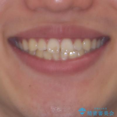 軽微叢生をインビザラインで 廉価版パッケージでの矯正治療の治療前(顔貌)