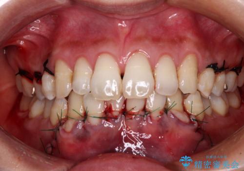 年々下がる歯茎を何とかしたい　歯肉移植術による根面被覆の治療後