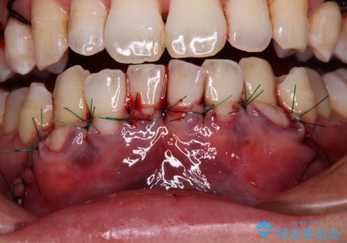 年々下がる歯茎を何とかしたい 歯肉移植術による根面被覆の治療中