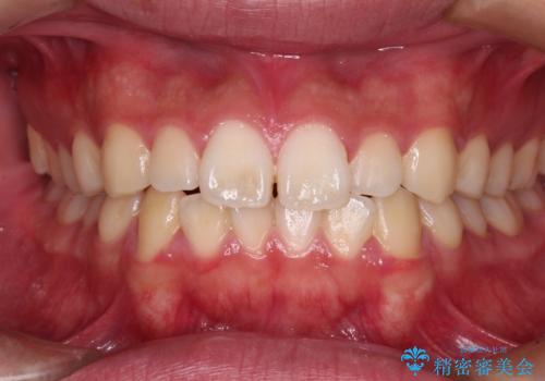軽微叢生をインビザラインで 廉価版パッケージでの矯正治療の症例 治療前