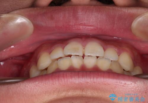 軽微叢生をインビザラインで 廉価版パッケージでの矯正治療の治療前