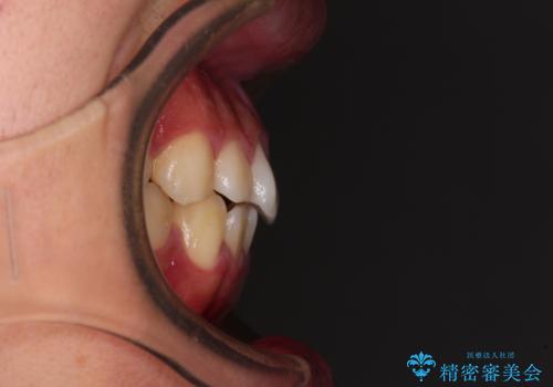 軽微叢生をインビザラインで 廉価版パッケージでの矯正治療の治療前