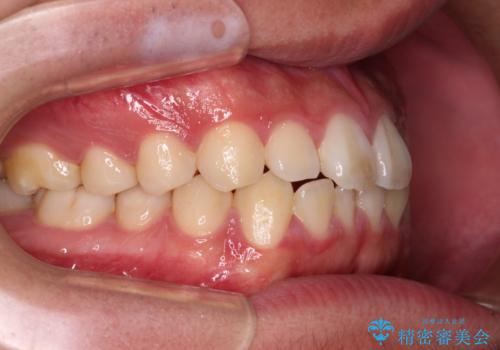 軽微叢生をインビザラインで 廉価版パッケージでの矯正治療の治療前