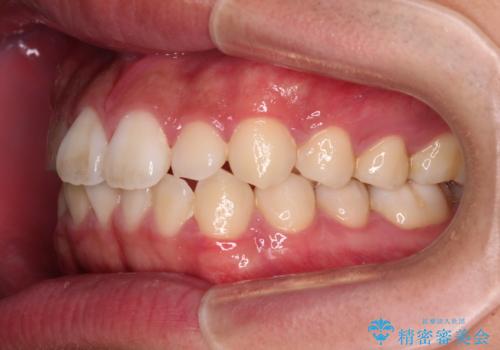 軽微叢生をインビザラインで 廉価版パッケージでの矯正治療の治療前