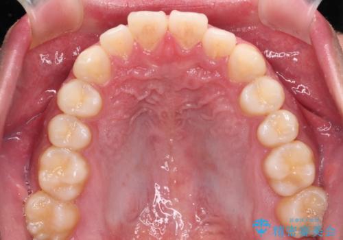 軽微叢生をインビザラインで 廉価版パッケージでの矯正治療の治療前