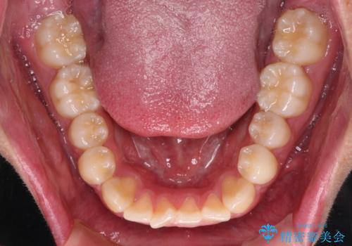 軽微叢生をインビザラインで 廉価版パッケージでの矯正治療の治療前