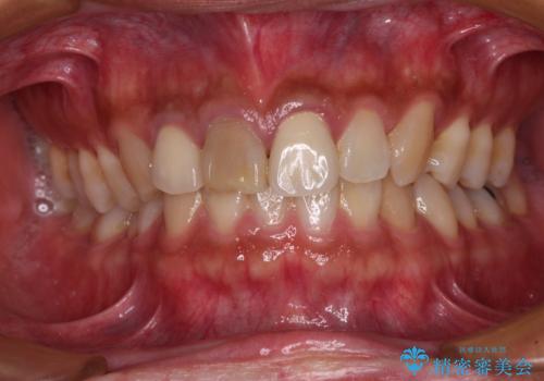 変色した前歯を治したい オールセラミッククラウンによる補綴の治療前