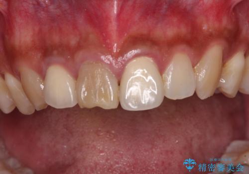 変色した前歯を治したい オールセラミッククラウンによる補綴の治療前