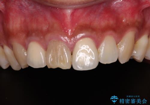 変色した前歯を治したい オールセラミッククラウンによる補綴の治療前