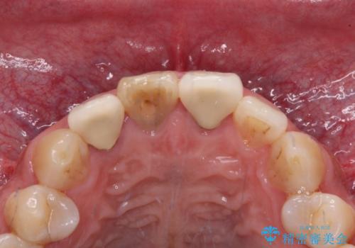 変色した前歯を治したい オールセラミッククラウンによる補綴の治療前
