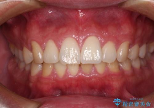 気になる前歯を短期間で改善　下顎の部分矯正と上顎のオールセラミッククラウン
