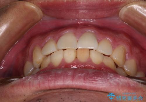 気になる前歯を短期間で改善　下顎の部分矯正と上顎のオールセラミッククラウンの治療後